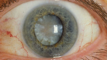 Tratamente alternative pentru dizolvarea cataractei