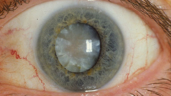 tratamentul cataractei vizuale