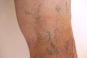 Etapele piciorului varicos - Care sunt cauzele aparitiei varicelor
