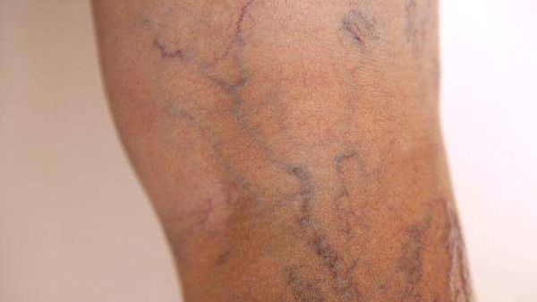 Durere în articulația genunchiului cu vene varicoase