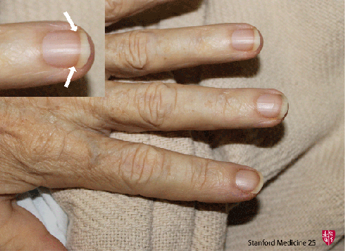 Boli ale articulației unghiilor - Articulația cotului doare cauze
