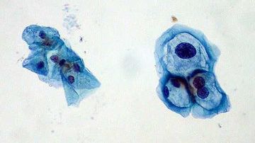 A fost descoperit un „leac” natural vegetal pentru HPV (virusul papiloma uman)