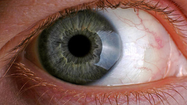 miopie și cataractă într-un singur ochi