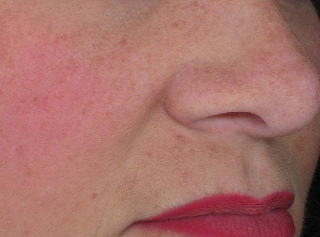 acnee rozacee