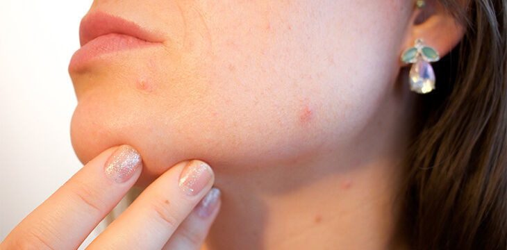 cea mai bună îngrijire anti-îmbătrânire a pielii predispusă la acnee)