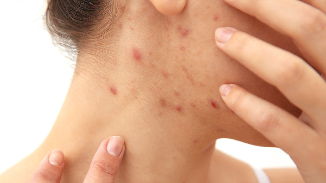 Cum combatem natural acneea hormonală?
